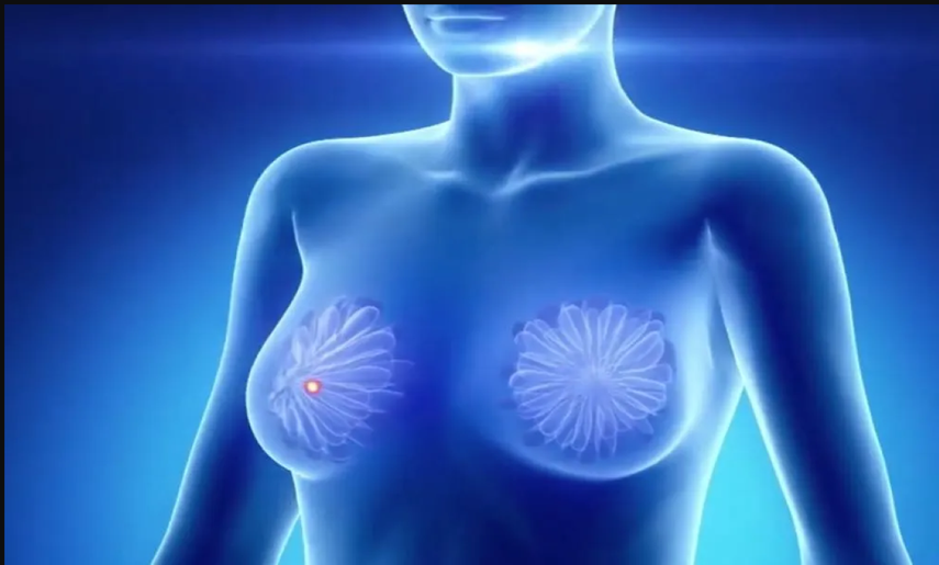 Cada año se registran 1,38 millones de nuevos casos de cáncer de mama, &nbsp;de los cuales 458.000 mueren, según la OMS.
