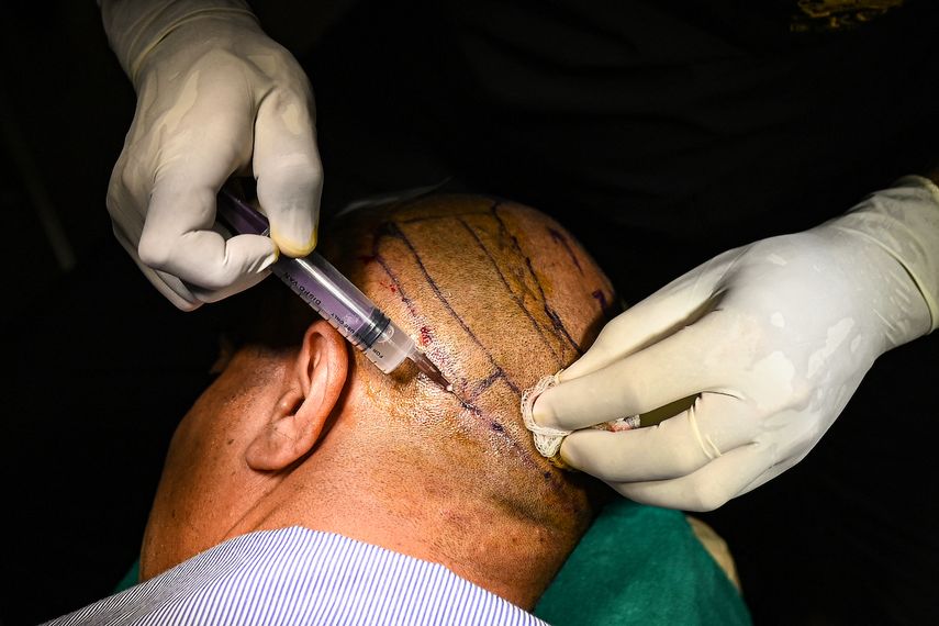 En esta fotografía tomada el 5 de noviembre de 2022, el Dr. Mayank Singh realiza una cirugía de trasplante de cabello en la clínica de trasplante de cabello Crown en Nueva Delhi, India. &nbsp;