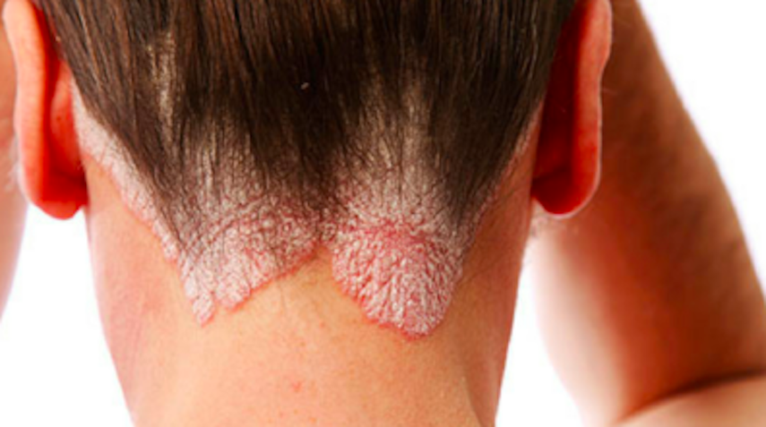 La humedad en el cuero cabelludo puede producir resequedad, por lo que puede generarse caspa o irritación.