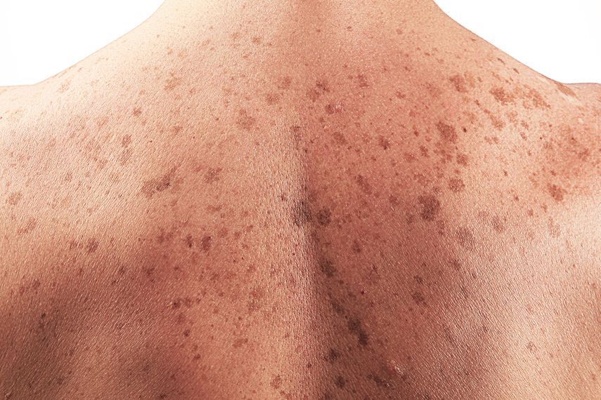 El lunar aparece mucho antes de que el cáncer se vuelva detectable a través del diagnóstico convencional.