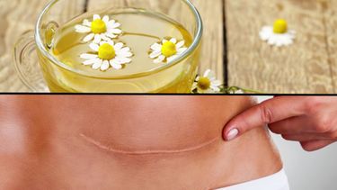 5 tips para borrar las cicatrices de manera natural