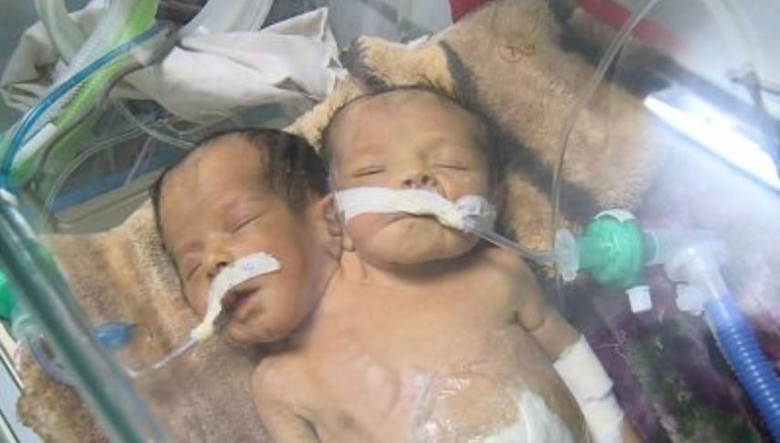 Dos bebés yemeníes de dos semanas unidos por el torso han muerto al no poder recibir tratamiento urgente en el extranjero.