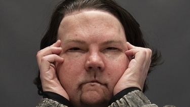 Un joven de 22 años que sufrió un horrible accidente automovilístico se convirtió en la primera persona del mundo que recibe un exitoso trasplante de cara y de ambas manos