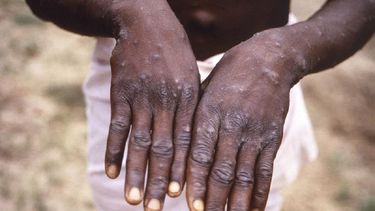 La viruela del mono supera los 50.000 casos en todo el mundo