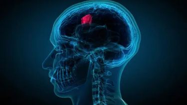 Imagen de un tumor cerebral 