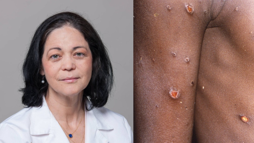DIARIO LAS AMERICAS conversó,en conjunto con KVC MEDIA, sobre la viruela del mono con la doctora Aileen Marty, experta en enfermedades infecciosas y profesora de Florida International University, que ha trabajado con la OMS y otras organizaciones durante los brotes de ébola, zika y más recientemente el COVID-19, cuando fundió como asesora del Condado Miami-Dade en Florida&nbsp;