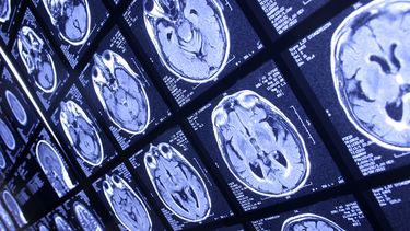 Una persona puede ser declarada muerta clínicamente aunque mantenga cierta actividad cardiaca y ventilatoria, si este depende de un soporte artificial.(Archivo)