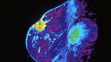 Seno sometido a exámenes debido al cáncer de mama.&nbsp;