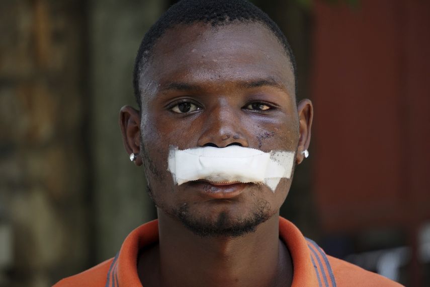 John Carey, de 21 años, quien resultó lesionado en las manifestaciones del viernes, posa para una foto en Puerto Príncipe, Haití, el 29 de septiembre de 2019. 