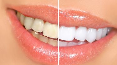 En ocasiones, es necesario el auxilio de otro tipo de tratamiento odontológico estético, como las carillas de porcelana o fundas. (Archivo)