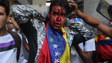 Un manifestante herido durante enfrentamientos con la Policía Nacional Bolivariana participa durante una protesta contra el dictador Maduro.