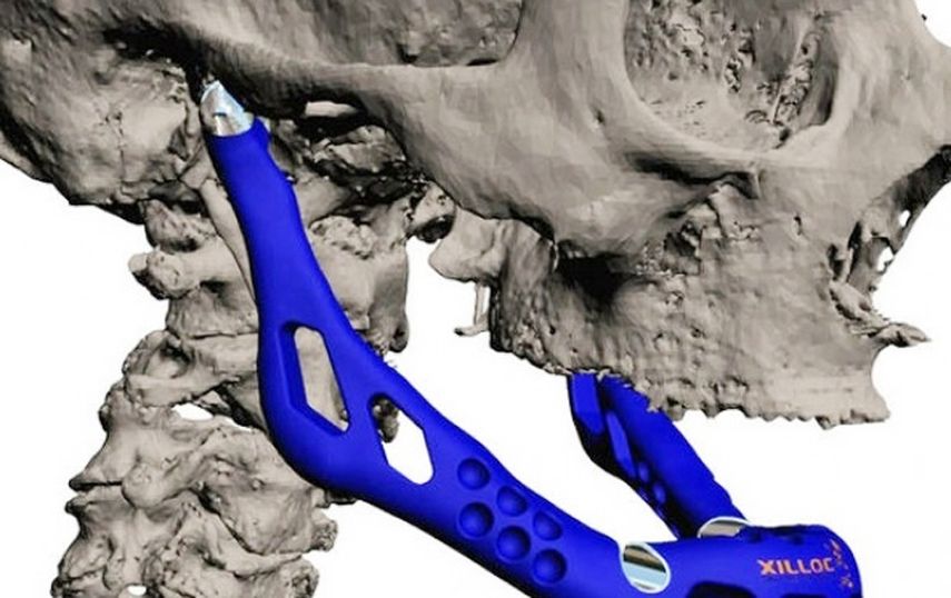Los investigadores esperan comenzar muy pronto la fabricación de estas prótesis de cerámica bioinerte. (Archivo)