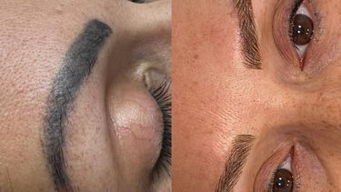 Antes y después de la remoción de cejas tatuadas, proceso que finaliza con la realización de la técnica del microblading.&nbsp;