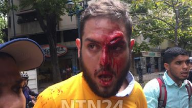 Imagen difundida por las redes sociales en la que se aprecia la magnitud de la agresión sufrida este lunes 3 de abril por el diputado opositor Juan Requesens, quien se manifestaba en las inmediaciones de la Defensoría del Pueblo en Venezuela.