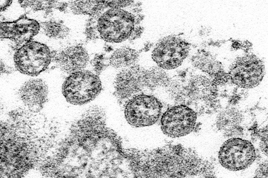 Esta imagen de microscopio cortes&iacute;a de los Centros para el Control y Prevenci&oacute;n de Enfermedades de Estados Unidos muestra part&iacute;culas esf&eacute;ricas de coronavirus del primer caso de COVID-19 en Estados Unidos.&nbsp;