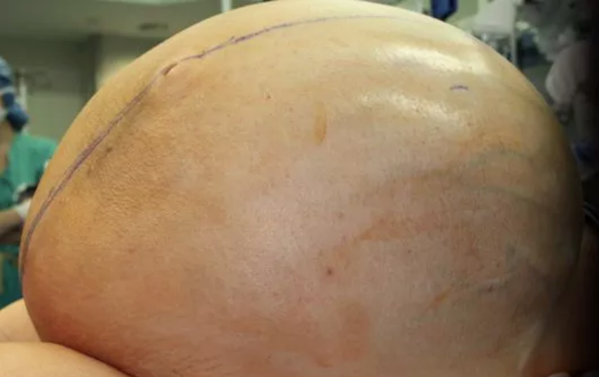 El enorme tumor medía unos 90 centímetros de diámetro.&nbsp;