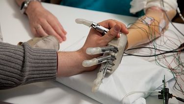 Dennis Aabo Sørensen muestra una nueva prótesis que le facilita el sentido del tacto a pesar de que perdió la mano en un accidente.(AP)