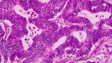 El estudio es para un tipo de cáncer pulmonar, carcinoma escamoso (Foto: Wikimedia)