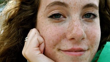 La predisposición a tener pecas es genética, y está relacionada con la presencia de la variante del gen receptor del melanocortin-1 MC1R. (Archivo)