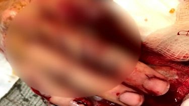 La víctima fue&nbsp;trasladada a urgencias de un hospital en Hollywood para ser operada.