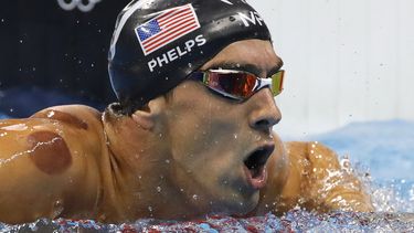 El estadounidense ha mostrado marcas circulares a la altura de sus hombros y espalda.