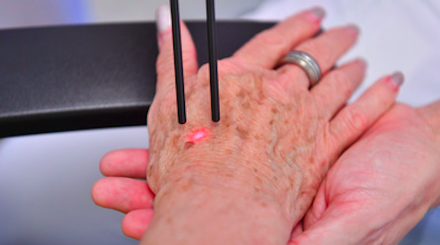 Las manos se ven muy expuestas a la radiación solar durante décadas. Allí es donde más suelen aparecer las manchas de la vejez.