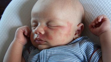 El origen de los angiomas es desconocido, aunque existen distintas teorías. (ARCHIVO)