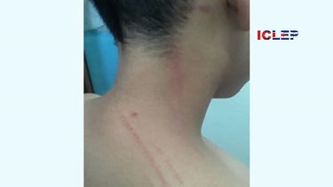 Lesiones provocadas al niño César Raidel Corzo Sánchez.&nbsp;
