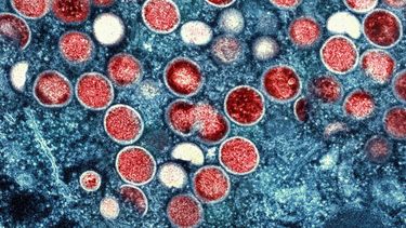 La Organización Mundial de la Salud declaró recientemente que el brote de viruela del simio en expansión es una emergencia mundial.&nbsp;